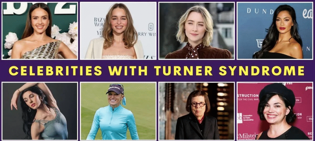 Understanding Turner Syndrome Celebrities